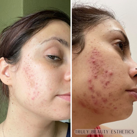  before and after Face reality acne boot camp Austin Texas